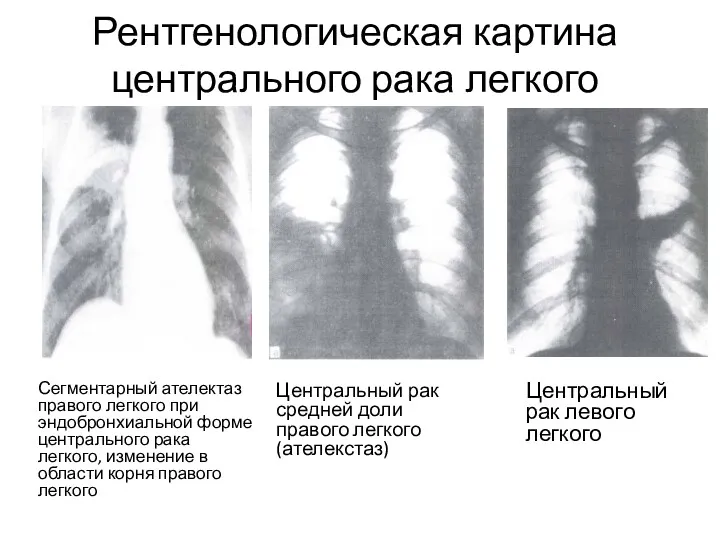 Рентгенологическая картина центрального рака легкого Центральный рак средней доли правого