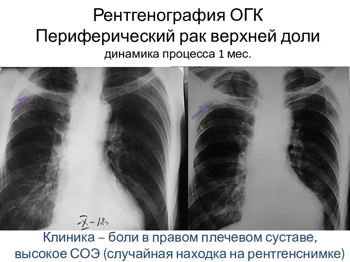 Рентгенография ОГК Периферический рак верхней доли динамика процесса 1 мес.