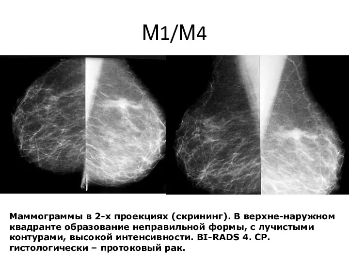 М1/М4 Маммограммы в 2-х проекциях (скрининг). В верхне-наружном квадранте образование