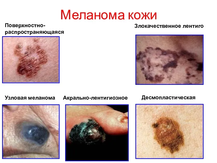 Меланома кожи Поверхностно- распространяющаяся Злокачественное лентиго Узловая меланома Акрально-лентигиозное Десмопластическая