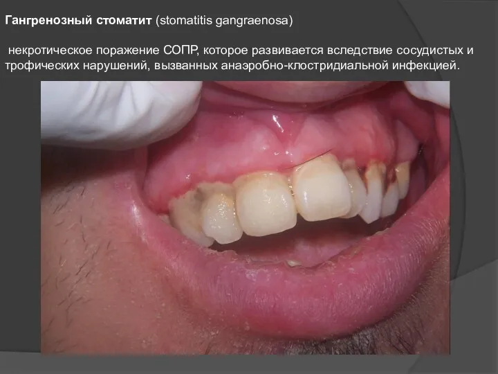 Гангренозный стоматит (stomatitis gangraenosa) некротическое поражение СОПР, которое развивается вследствие