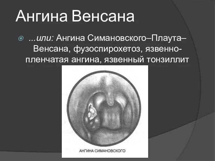 Ангина Венсана ...или: Ангина Симановского–Плаута–Венсана, фузоспирохетоз, язвенно-пленчатая ангина, язвенный тонзиллит