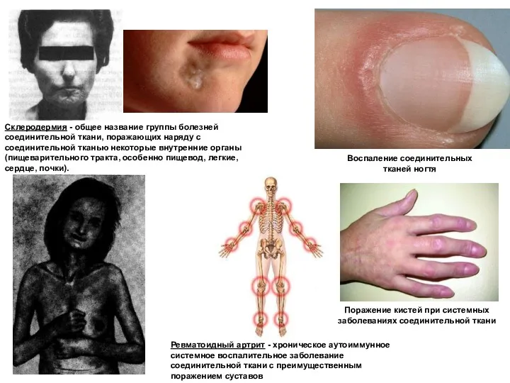 Склеродермия - общее название группы болезней соединительной ткани, поражающих наряду с соединительной тканью