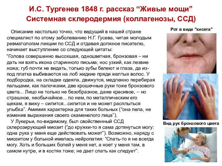 И.С. Тургенев 1848 г. рассказ “Живые мощи” Системная склеродермия (коллагенозы, ССД) Описание настолько