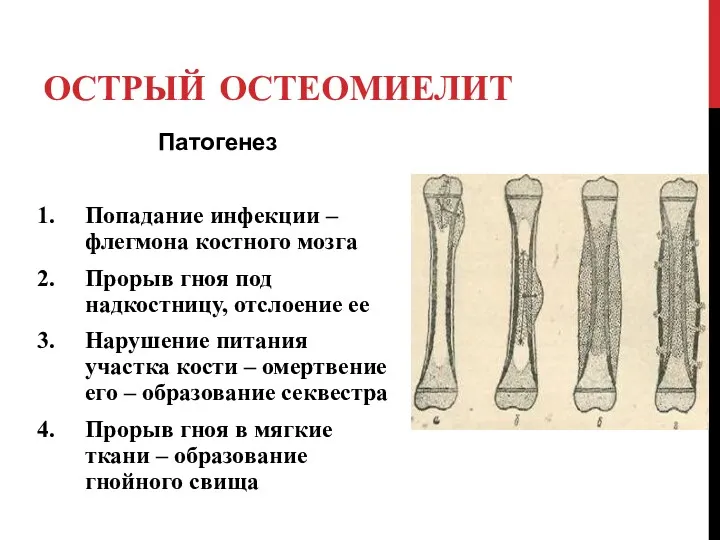 ОСТРЫЙ ОСТЕОМИЕЛИТ Патогенез Попадание инфекции – флегмона костного мозга Прорыв