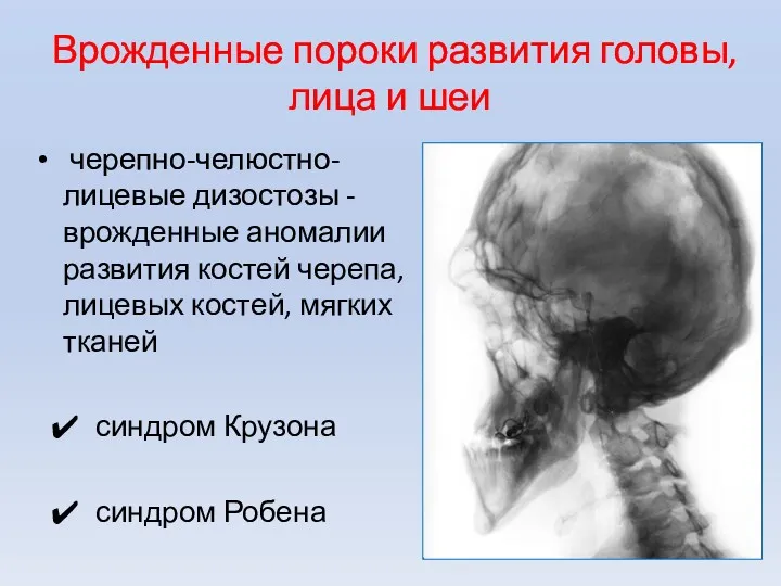 Врожденные пороки развития головы, лица и шеи черепно-челюстно-лицевые дизостозы -