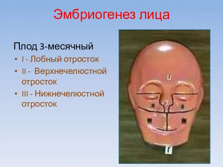 Эмбриогенез лица Плод 3-месячный I - Лобный отросток II - Верхнечелюстной отросток III - Нижнечелюстной отросток