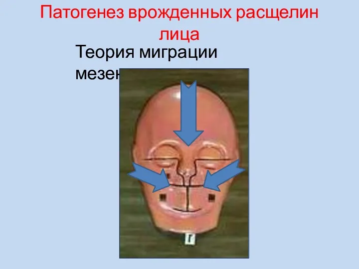 Патогенез врожденных расщелин лица Теория миграции мезенхимы