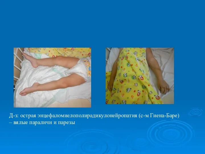 Д-з: острая энцефаломиелополирадикулонейропатия (с-м Гиена-Баре) – вялые параличи и парезы