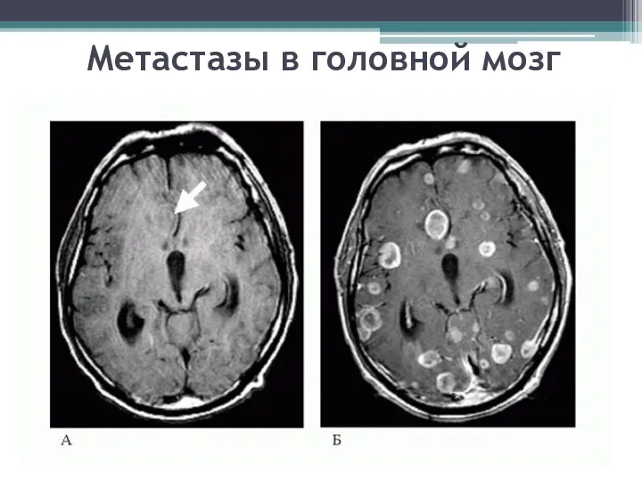 Метастазы в головной мозг