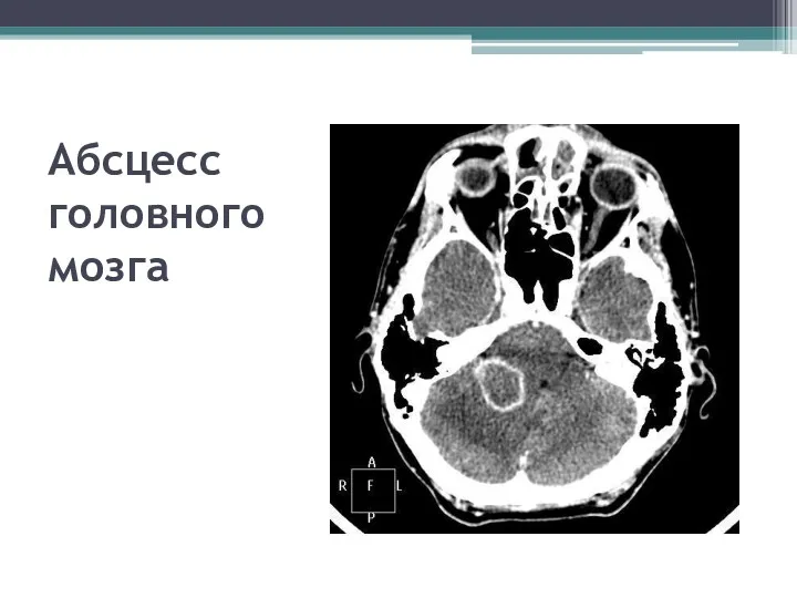 Абсцесс головного мозга