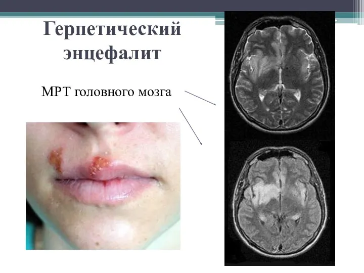 Герпетический энцефалит МРТ головного мозга