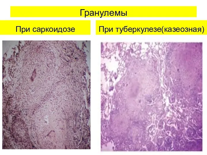 Гранулемы При саркоидозе При туберкулезе(казеозная)