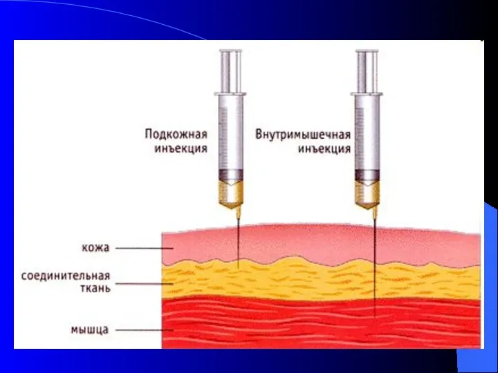 Подкожные инъекции производится обычно в области плеча или в подкожную