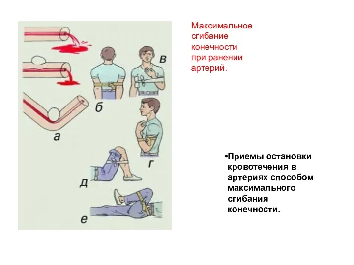 Приемы остановки кровотечения в артериях способом максимального сгибания конечности. Максимальное сгибание конечности при ранении артерий.