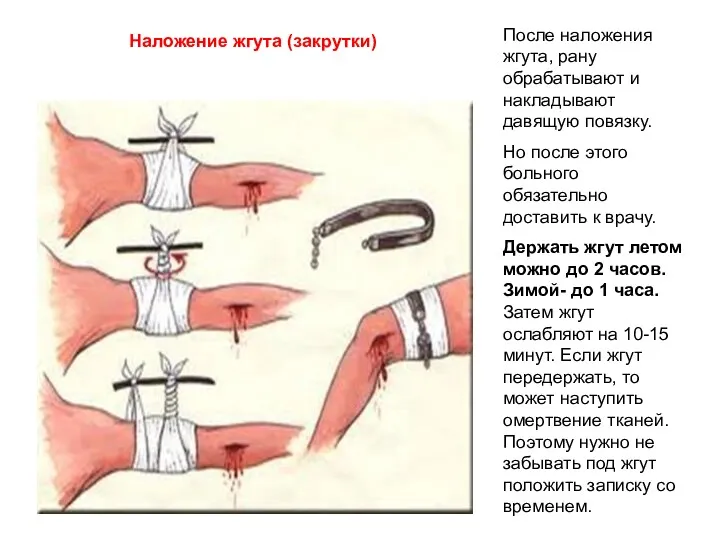 Наложение жгута (закрутки) После наложения жгута, рану обрабатывают и накладывают