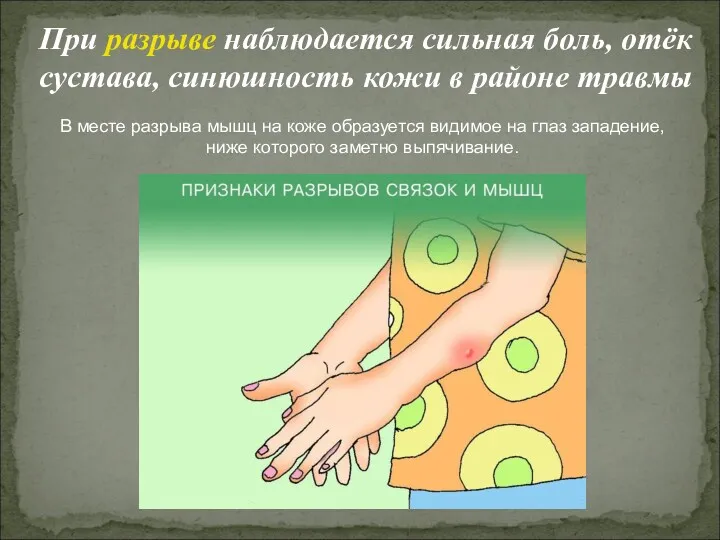 При разрыве наблюдается сильная боль, отёк сустава, синюшность кожи в