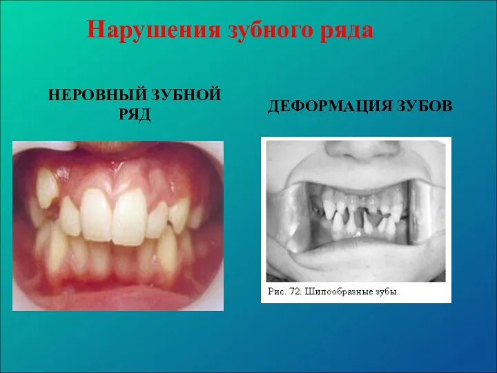 Нарушения зубного ряда НЕРОВНЫЙ ЗУБНОЙ РЯД ДЕФОРМАЦИЯ ЗУБОВ