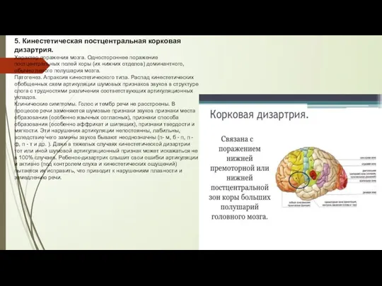 5. Кинестетическая постцентральная корковая дизартрия. Характер поражения мозга. Одностороннее поражение