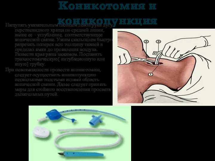 Коникотомия и коникопункция Нащупать указательным пальцем левой руки дугу перстневидного