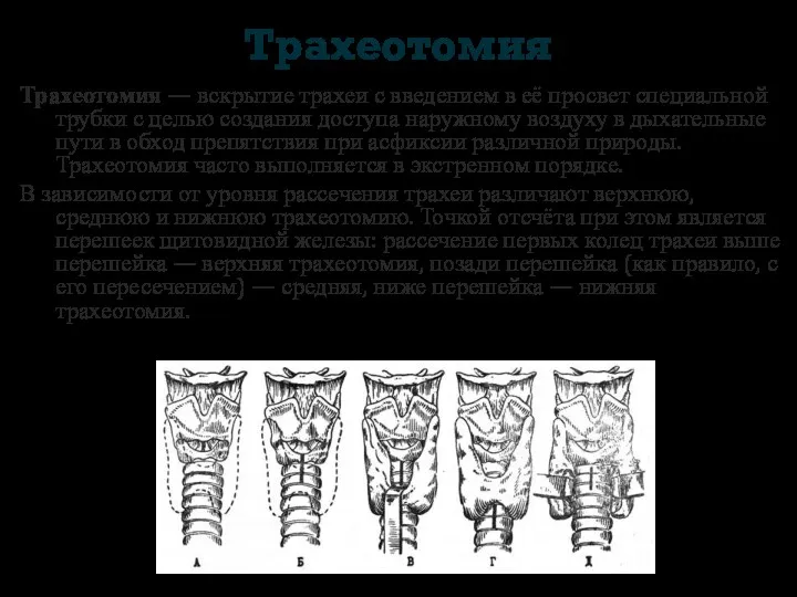 Трахеотомия Трахеотомия — вскрытие трахеи с введением в её просвет
