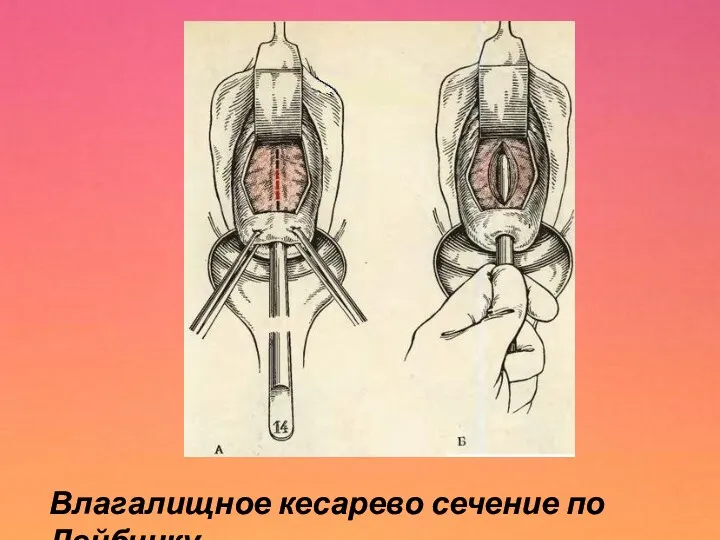 Влагалищное кесарево сечение по Лейбчику