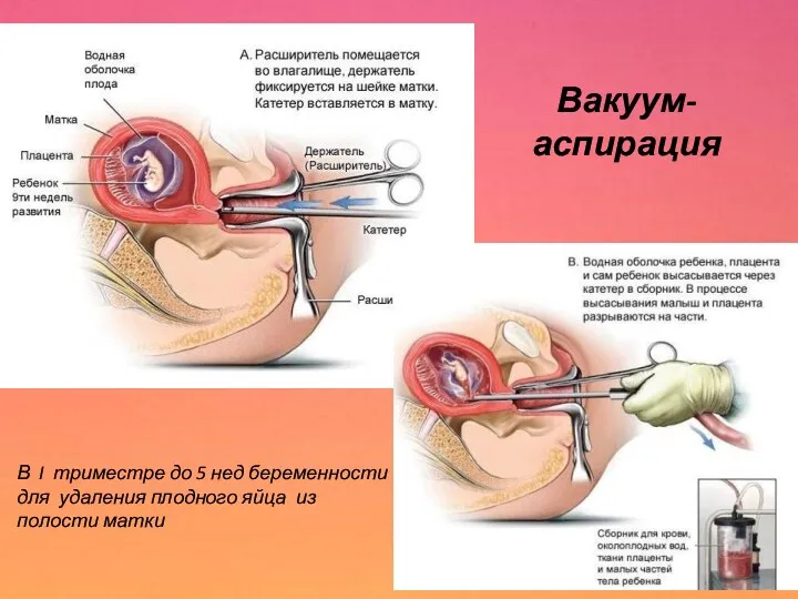 Вакуум- аспирация В I триместре до 5 нед беременности для удаления плодного яйца из полости матки