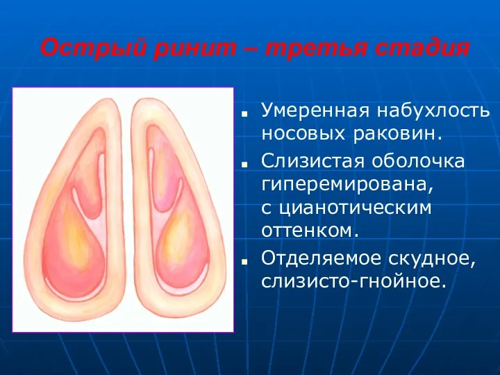 Острый ринит – третья стадия Умеренная набухлость носовых раковин. Слизистая