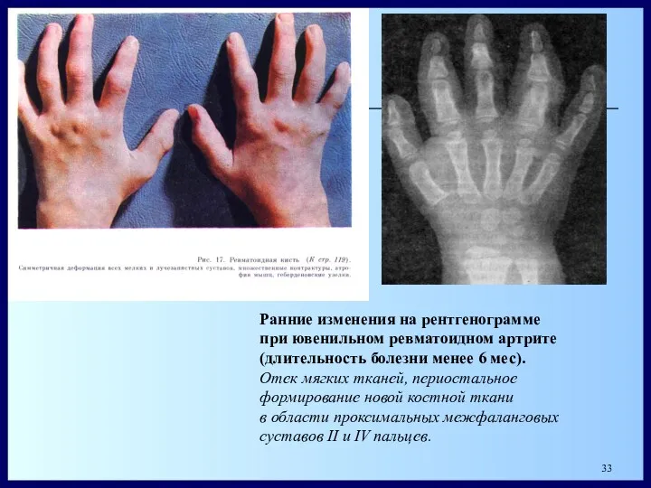 Ранние изменения на рентгенограмме при ювенильном ревматоидном артрите (длительность болезни