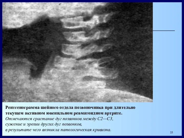 Рентгенограмма шейного отдела позвоночника при длительно текущем активном ювенильном ревматоидном