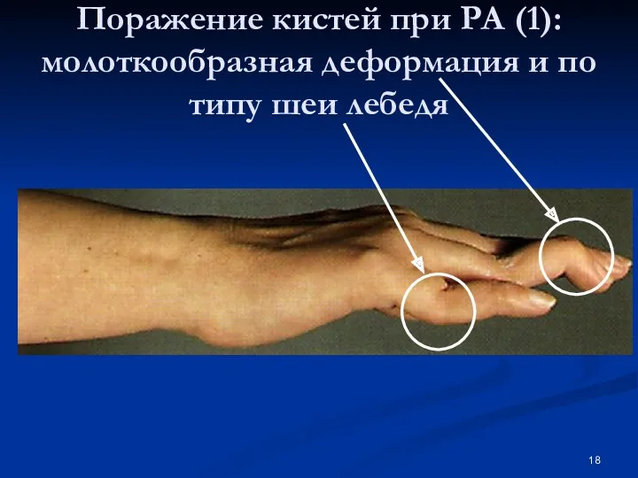 Поражение кистей при РА (1): молоткообразная деформация и по типу шеи лебедя