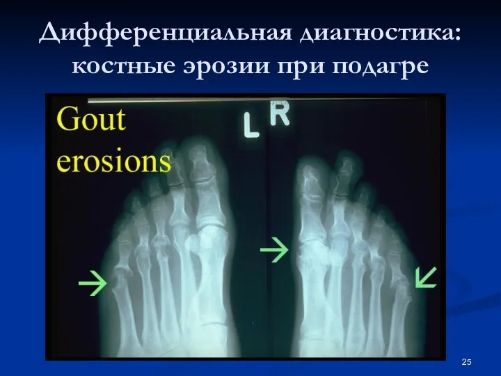 Дифференциальная диагностика: костные эрозии при подагре