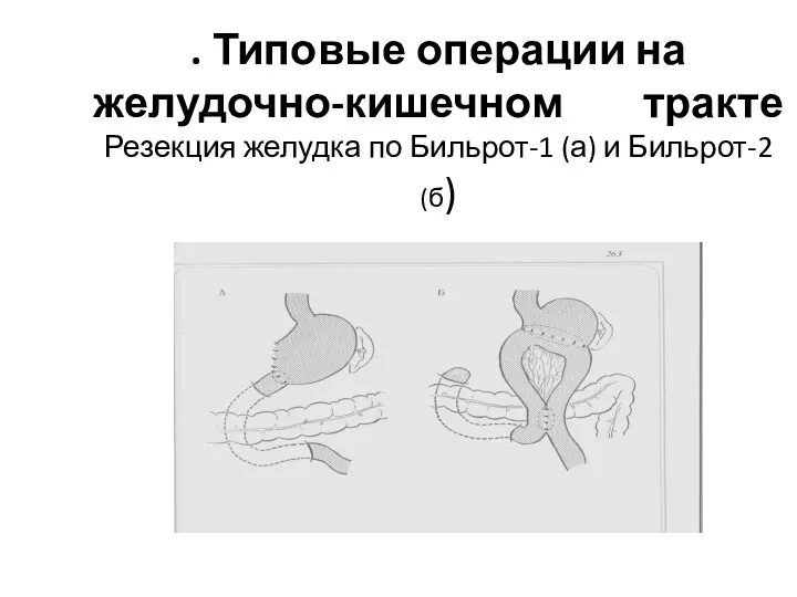 . Типовые операции на желудочно-кишечном тракте Резекция желудка по Бильрот-1 (а) и Бильрот-2 (б)