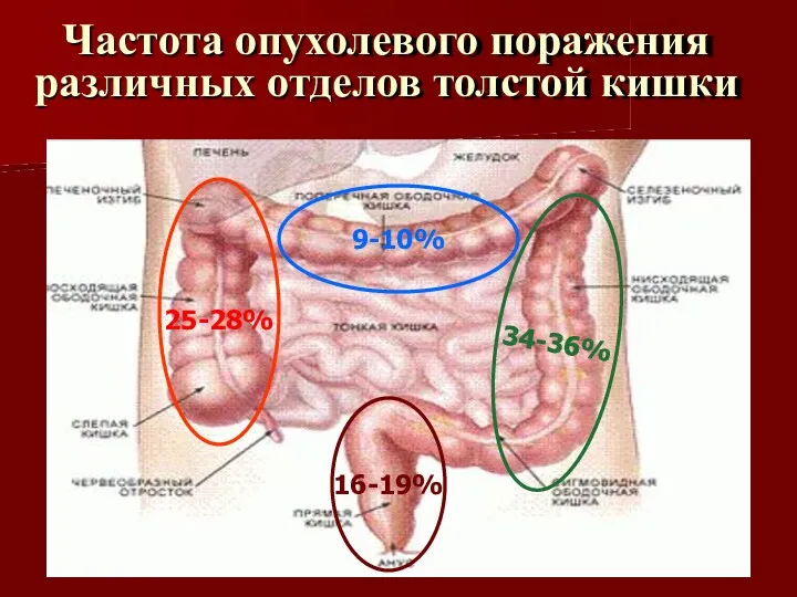 Частота опухолевого поражения различных отделов толстой кишки 9-10% 25-28% 16-19%