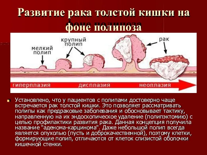 Развитие рака толстой кишки на фоне полипоза Установлено, что у