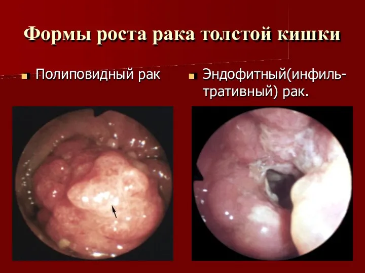 Формы роста рака толстой кишки Полиповидный рак Эндофитный(инфиль- тративный) рак.