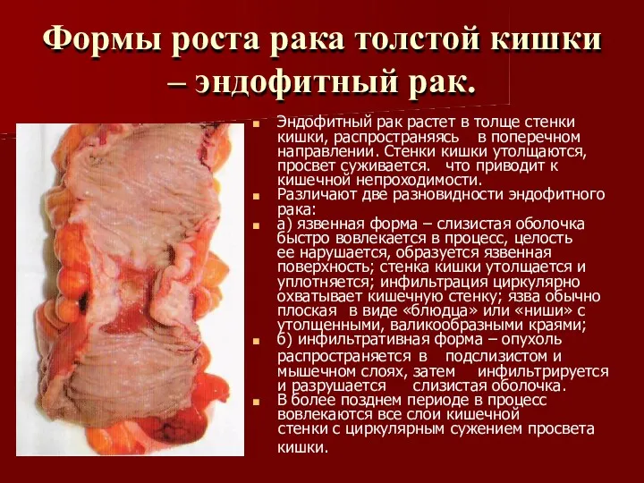 Формы роста рака толстой кишки – эндофитный рак. Эндофитный рак