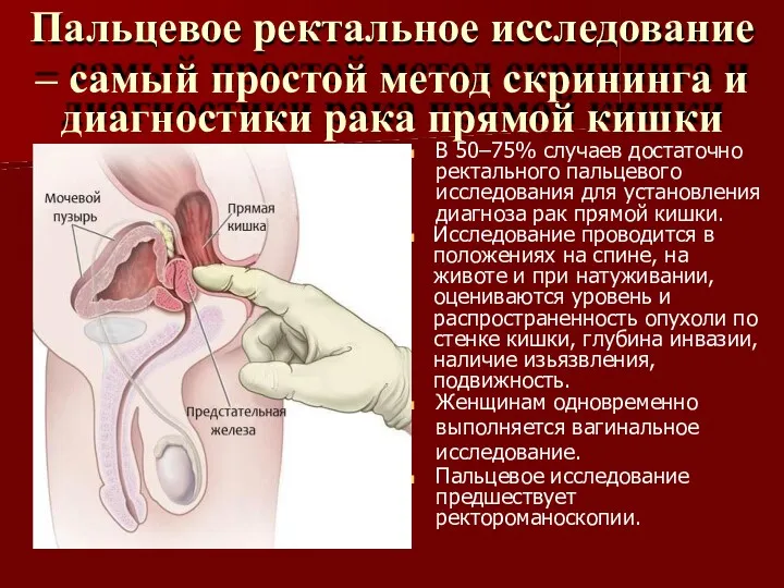 Пальцевое ректальное исследование – самый простой метод скрининга и диагностики