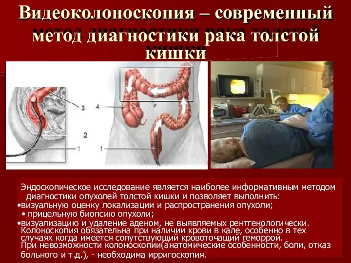 Видеоколоноскопия – современный метод диагностики рака толстой кишки Эндоскопическое исследование