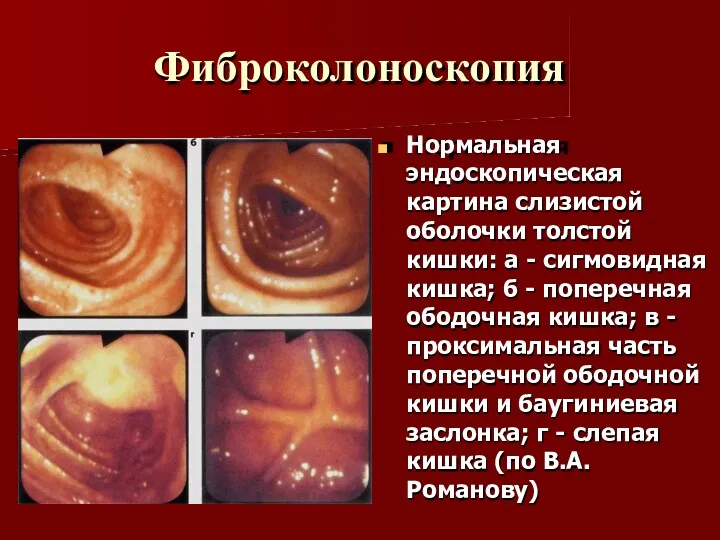 Фиброколоноскопия Нормальная эндоскопическая картина слизистой оболочки толстой кишки: а -