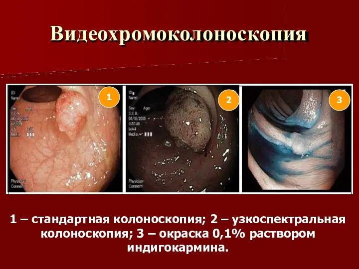 Видеохромоколоноскопия 2 1 3 1 – стандартная колоноскопия; 2 –