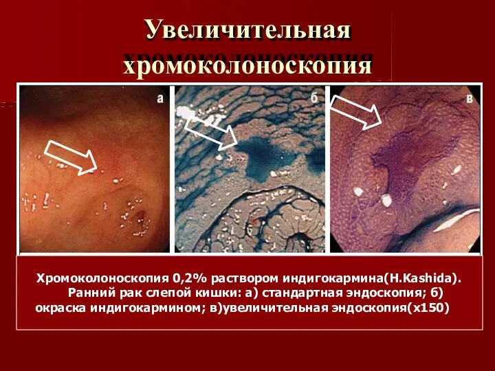 Увеличительная хромоколоноскопия Хромоколоноскопия 0,2% раствором индигокармина(H.Kashida). Ранний рак слепой кишки: