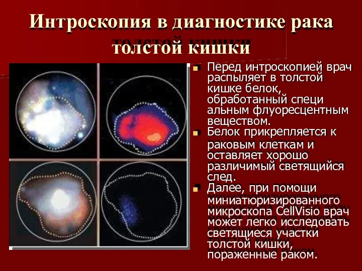 Интроскопия в диагностике рака толстой кишки Перед интроскопией врач распыляет