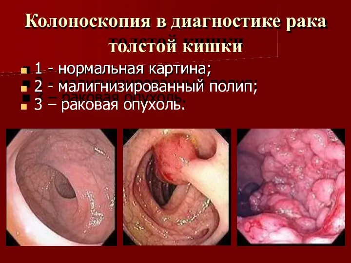 Колоноскопия в диагностике рака толстой кишки 1 - нормальная картина;