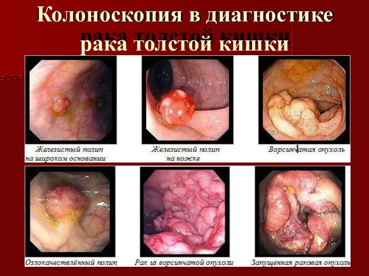 Колоноскопия в диагностике рака толстой кишки