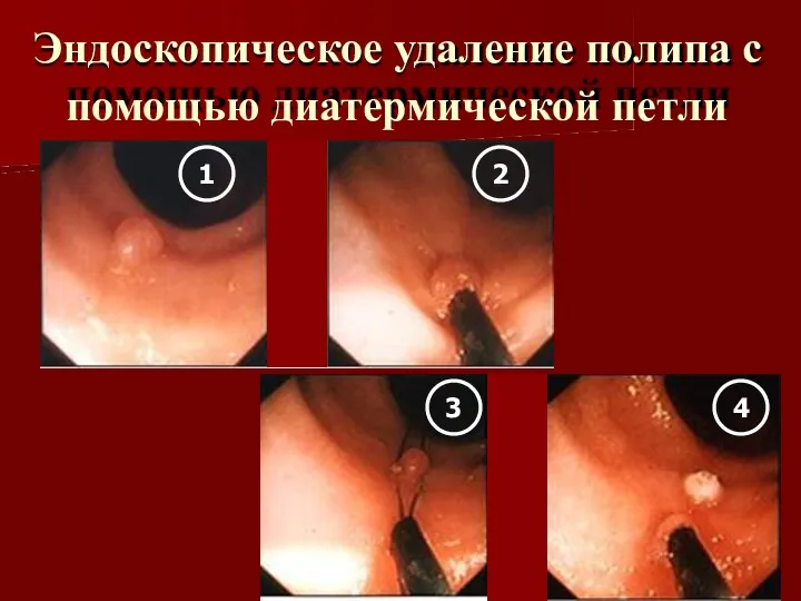 Эндоскопическое удаление полипа с помощью диатермической петли 1 4 3 2