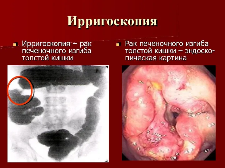 Ирригоскопия Ирригоскопия – рак печеночного изгиба толстой кишки Рак печеночного