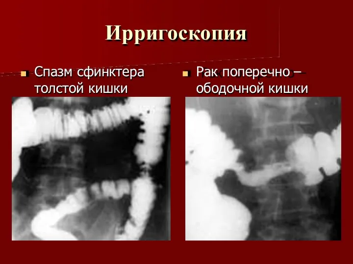 Ирригоскопия Спазм сфинктера толстой кишки Рак поперечно – ободочной кишки