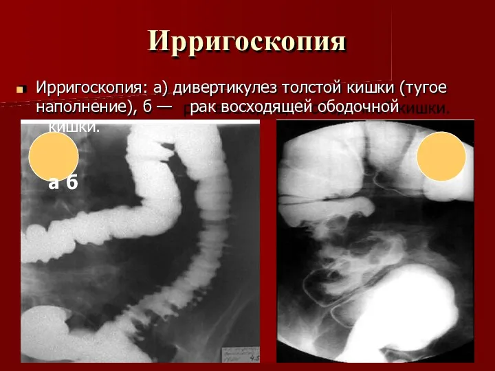 Ирригоскопия Ирригоскопия: а) дивертикулез толстой кишки (тугое наполнение), б — рак восходящей ободочной кишки. а б