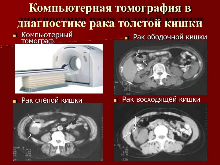 Компьютерная томография в диагностике рака толстой кишки Компьютерный томограф Рак